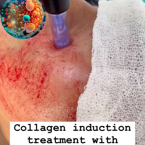 Witness the power of EXOSOMES in our clinical treatment for acne scar, acne marks and damaged skin. 