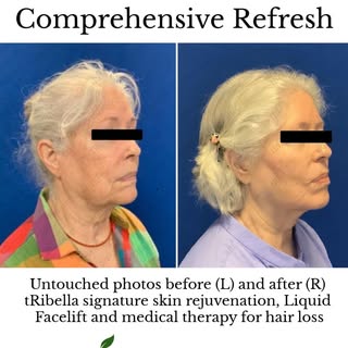 Our beautiful patient received our signature tRibella series, as well as our signature Liquid Faceli