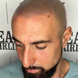 18 month healed treatment topped up with a little extra detail to keep things popping. Swipe for bef