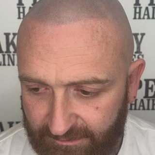 Hairline restored ✔️ Swipe for before 🙏🏽

Scalp micropigmentation (SMP) aka hair tattoo in Kent..
