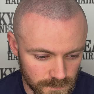 Hairline restored and density added throughout as and where required. Please swipe for before to see