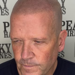 Another hairline restored ready for the summer 😎 Please swipe before 🙏🏽

Scalp micropigmentation 