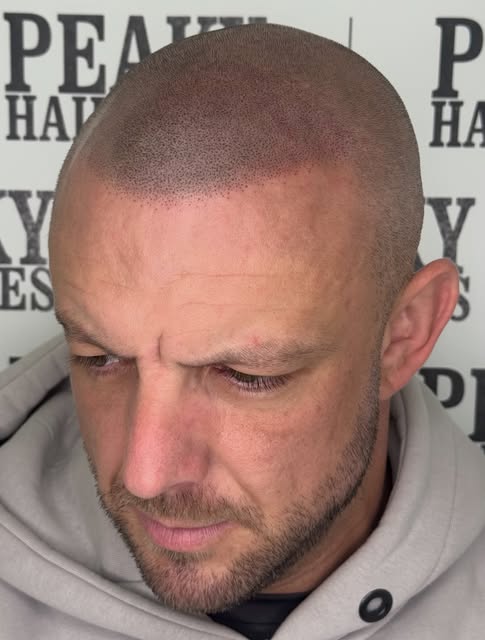 Hairline restored and density added throughout as and where needed. Please swipe to see where we sta