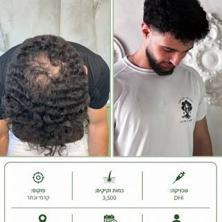 ▫️ שיטה: DHI
▫️ מדינה: אירופה
▫️ מספר זקיקים: 3,500
▫️ סטטוס: 10 חודשים לאחר ההשתלה!

אופק אבידן עבר