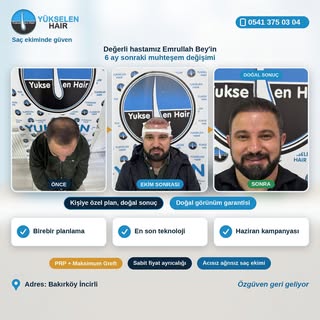 Saç ekimini gerçekleştirdiğimiz değerli hastamız Emrullah Bey'in 6 ay sonraki muhteşem değişimi. Biz