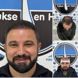 Saç ekimini gerçekleştirdiğimiz değerli hastamız Emrah Bey'in 6 ay sonraki muhteşem değişimi. Bizler