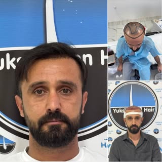 Saç ekimini gerçekleştirdiğimiz değerli hastamız Fuat Bey'in 1 yıl sonraki muhteşem değişimi. Bizler