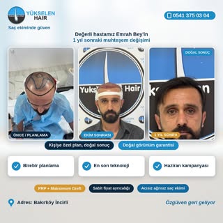 Saç ekimini gerçekleştirdiğimiz değerli hastamız Fuat Bey'in 1 yıl sonraki muhteşem değişimi. Bizler