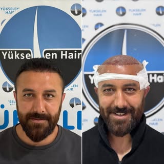 Saç ekimini gerçekleştirdiğimiz değerli hastamız Ramazan Bey'in 6 ay sonraki muhteşem değişimi. Bizl