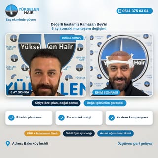 Saç ekimini gerçekleştirdiğimiz değerli hastamız Ramazan Bey'in 6 ay sonraki muhteşem değişimi. Bizl