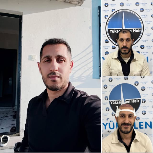 Saç ekimini gerçekleştirdiğimiz değerli hastamız İlyas Bey'in 7 ay sonraki muhteşem değişimi. Bizler