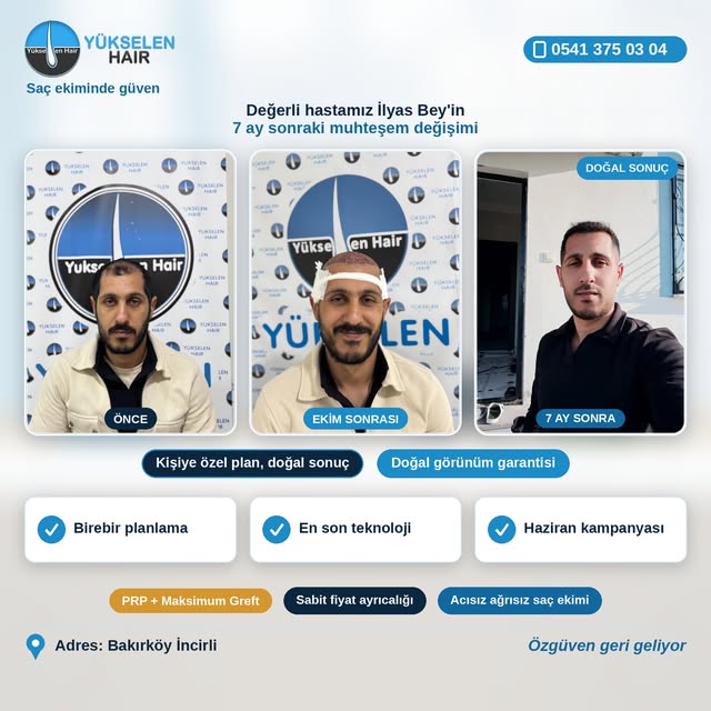 Saç ekimini gerçekleştirdiğimiz değerli hastamız İlyas Bey'in 7 ay sonraki muhteşem değişimi. Bizler