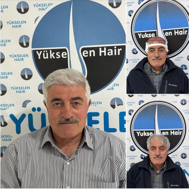 Saç ekimini gerçekleştirdiğimiz değerli hastamız Salim Bey'in 8 ay sonraki muhteşem değişimi. Bizler