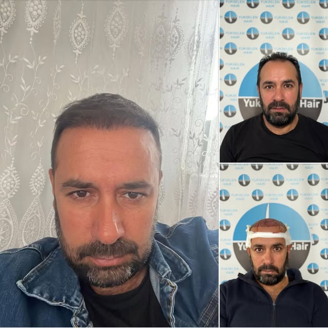 Saç ekimini gerçekleştirdiğimiz değerli hastamız Muhsin Bey'in 6 ay sonraki muhteşem değişimi. Bizle