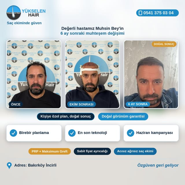 Saç ekimini gerçekleştirdiğimiz değerli hastamız Muhsin Bey'in 6 ay sonraki muhteşem değişimi. Bizle