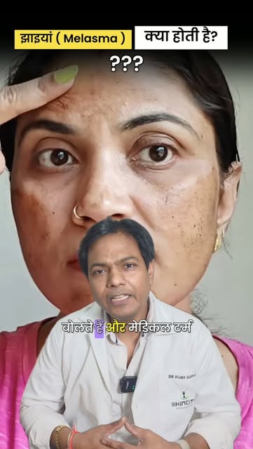 झाइयों (Melasma) का सच! बिना डॉक्टर की सलाह के क्रीम क्यों न लगाएं? | Dr. Vijay Gupta
.
.
.
क्या आपक