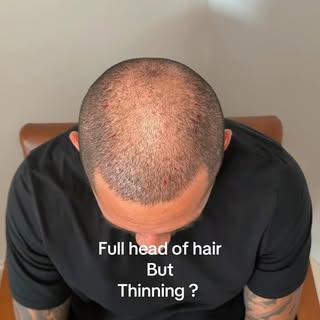 The magic of SMP IS INCREDIBLE,INSTANT & TRANSFORMATIVE !! 

He is keeping his hair short with a #1 