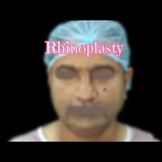Rhinoplasty or nose correction 
visit us @
🌐www.reflektaesthetics.com
☎️WhatsApp 9042997408