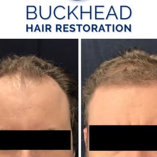 Before and After 📸
6 months post FUE Hair Transplant. 
Dr. Slater and Team transferred 3,500 grafts