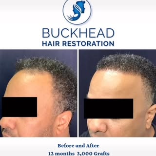 Before and After Hair Transplant
Patient received 3,000 grafts to improve hair line and crown of the