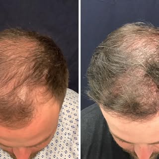 Before and After 📸
6 months post FUE Hair Transplant. 
Dr. Slater and Team transferred 3,000 grafts