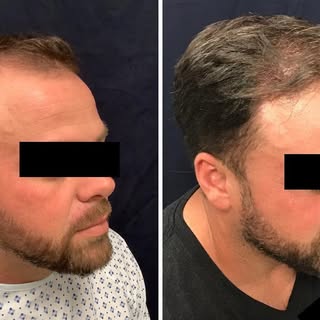 Before and After 📸
6 months post FUE Hair Transplant. 
Dr. Slater and Team transferred 3,000 grafts
