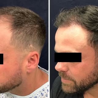 Before and After 📸
6 months post FUE Hair Transplant. 
Dr. Slater and Team transferred 3,000 grafts