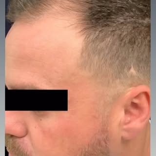 Before and After 📸
6 months post FUE Hair Transplant. 
Dr. Slater and Team transferred 3,000 grafts