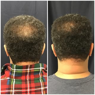 Before and After 1 Anteage Hair Restoration Treatment  Summer Special: 
Ante-Age Hair Restoration Tr