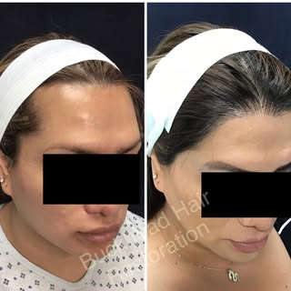 Before and After 📸
12 months post FUE Hair Transplant. 
Dr. Slater and Team transferred 3,000 graft