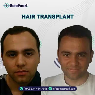 Hair transplant operations in Turkey, the best hair transplant crew, life-time guarantee.
.
.
 #hair
