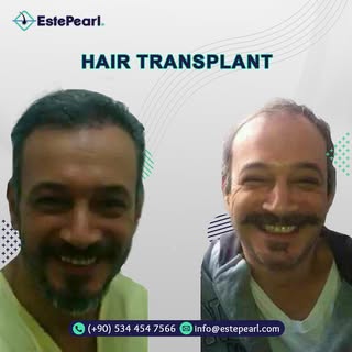 Hair transplant operations in Turkey, the best hair transplant crew, life-time guarantee.
.
.
 #hair