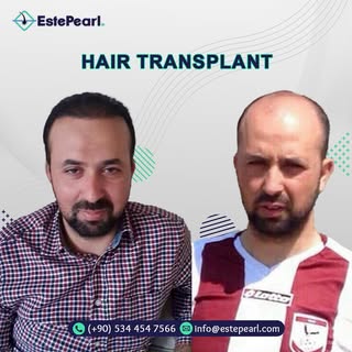 Hair transplant operations in Turkey, the best hair transplant crew, life-time guarantee.
.
.
 #hair