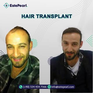 Hair transplant operations in Turkey, the best hair transplant crew, life-time guarantee.
.
.
 #hair
