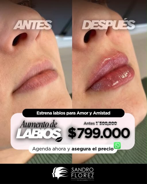 Labios perfectos para celebrar Amor y Amistad 😘 El Dr. Sandro Florez te espera para convertir tus s