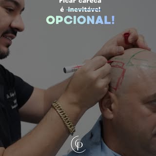 ✨ Ficar careca não precisa ser o seu destino.

Com o transplante capilar, é possível recuperar não a