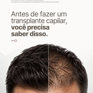 O transplante capilar é uma excelente solução, mas não interrompe a evolução da calvície.

Os fios t