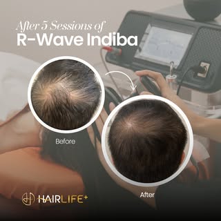 5 Sessions, Big Results! 🌟

After just 5 sessions of R-Wave Indiba, I’ve noticed a significant impr