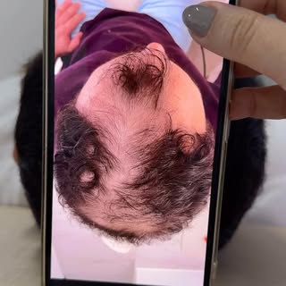 Comenta aqui o que achou do resultado! 
A calvície não tem cura, mas pode ser tratada eficazmente!
F
