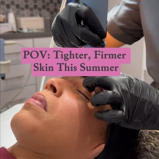 RF Microneedling is one of the most requested treatments right now for people wanting tighter, smoot