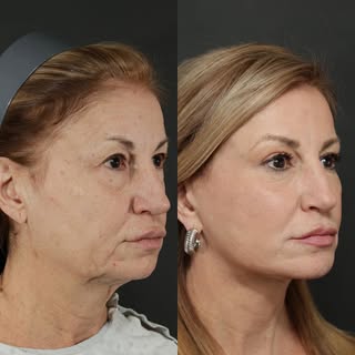 All I can say is “wow!!!” I was so excited to see my amazing patient five months after full-face sur