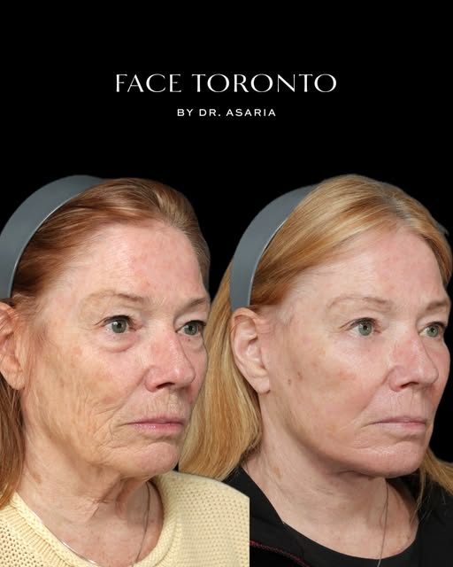 People don’t want to look like a different human after facial rejuvenation surgery. They don’t want 