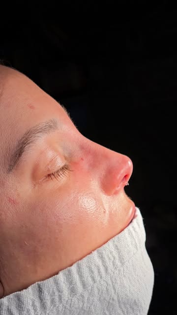 Simple. Elegant. Timeless. 
Rhinoplasty by Dr. Asaria. 
#naturalresults #nose #face #beauty #rhinopl