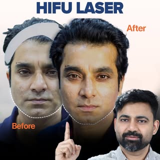 Face sagging, double chin, or a jawline that’s losing definition? 

Non-surgical, safe, and natural 