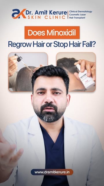 Does Minoxidil actually grow new hair or just stop hair fall?

Minoxidil boosts blood circulation in