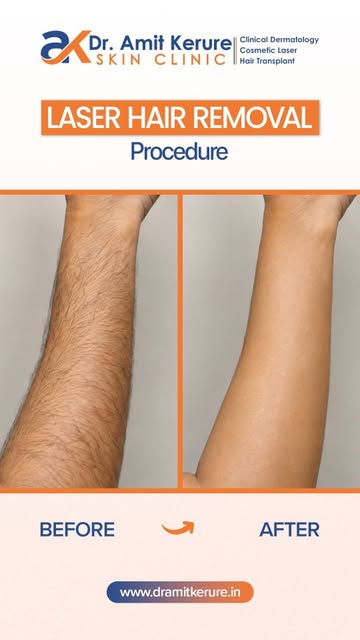 Are you tired of shaving and waxing again and again?

Upgrade your routine with Laser Hair Reduction