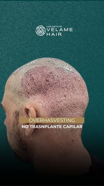 Você já ouviu falar em overharvesting no transplante capilar?

Esse termo é usado quando há uma reti