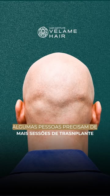 Por que algumas pessoas precisam de mais de uma sessão de transplante capilar?

Porque cada caso tem