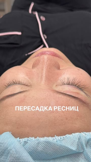 Пересадка ресниц — способ сделать ресницы более густыми и выразительными с помощью собственных волос