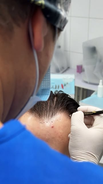 3 степень облысения — уже заметные изменения линии роста волос и углубление лобно-височных зон.

На 